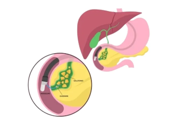 Advanced ERCP Procedures----0